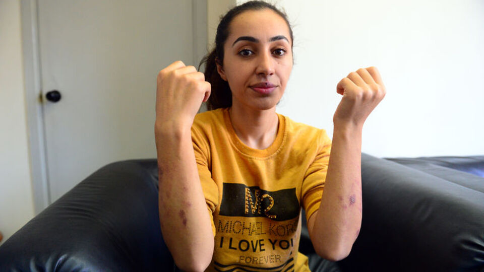 Lazer epilasyonda kabusu yaşadı