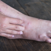 Dikkat! Küçücük bir yarayla başlıyor, hayatı zindan ediyor!