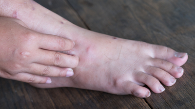 Dikkat! Küçücük bir yarayla başlıyor, hayatı zindan ediyor!