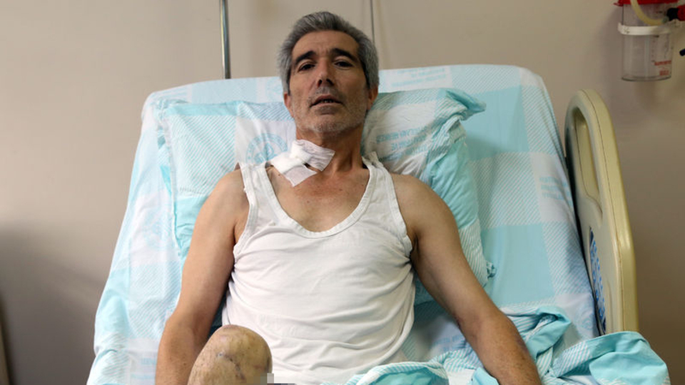 Doku nakli ile bacağı kesilmekten kurtuldu