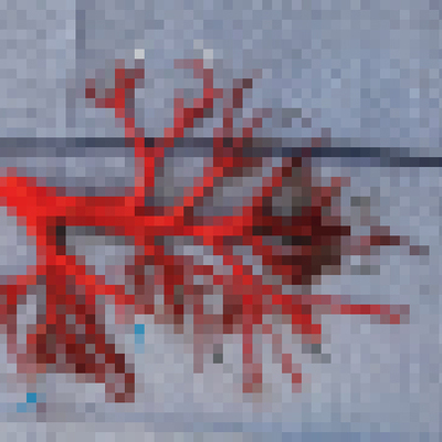 İnanılmaz olay! Öksürünce akciğeri koptu...