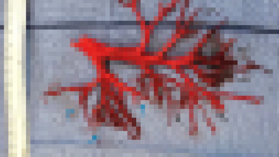 İnanılmaz olay! Öksürünce akciğeri koptu...