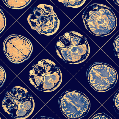 Beynini amipler yedi!