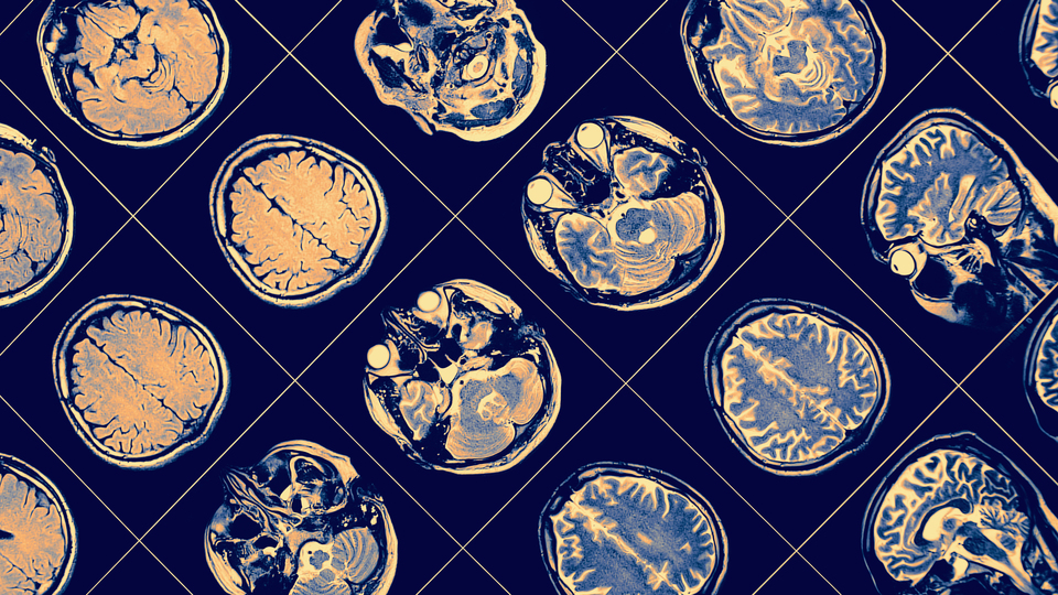 Beynini amipler yedi!