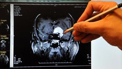 Dikkat! Belirti vermeden ilerliyor...