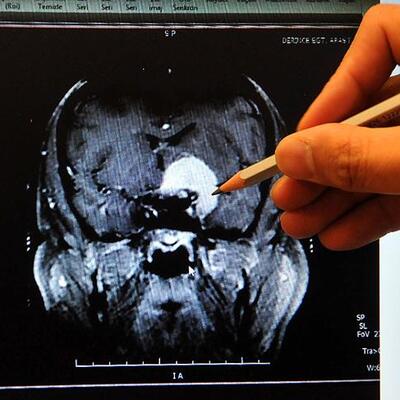 Dikkat! Belirti vermeden ilerliyor...