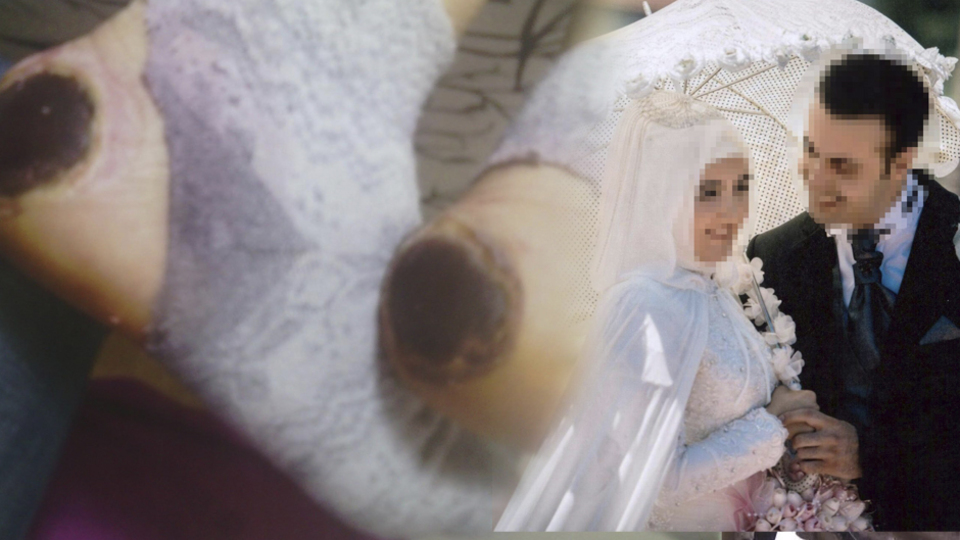 Genç kadının topukları bu hale gelmişti! Korkunç olayda flaş gelişme!