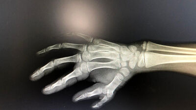 Başparmak fazlalığı olan çocuk sağlığına kavuştu