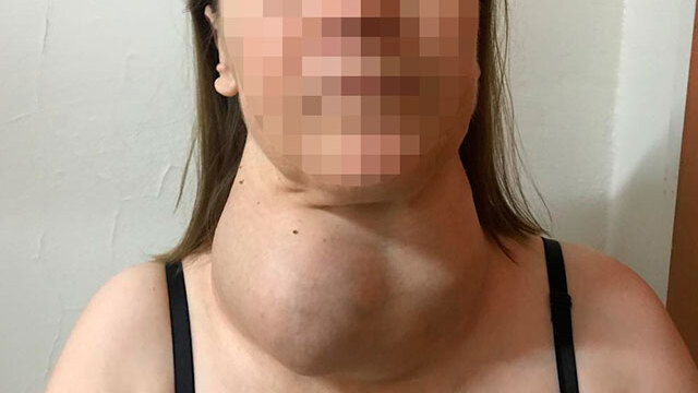 Ameliyattan korktu, yıllarca böyle yaşadı!
