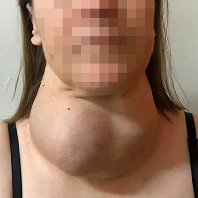 Ameliyattan korktu, yıllarca böyle yaşadı!
