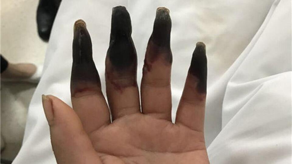 Küçücük bir kesik onu bu hale getirdi! Dikkat sizin de başınıza gelebilir!