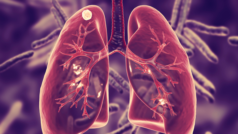 Dikkat! En çok öldüren 10 hastalıktan biri...