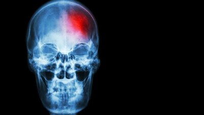 İnmeyi yüzde 90 engelleyecek formül