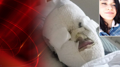 Yüzüne döktüğü sıvı montu eritti! Platonik aşık, bu hale getirdi!