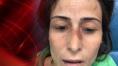 Eşinin kemiklerini kıran doktora takdir indirimi ile ceza çıkmadı!