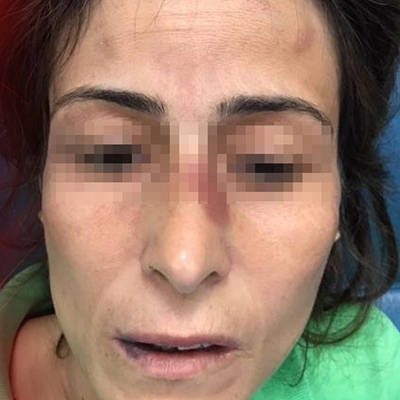 Eşinin kemiklerini kıran doktora takdir indirimi ile ceza çıkmadı!