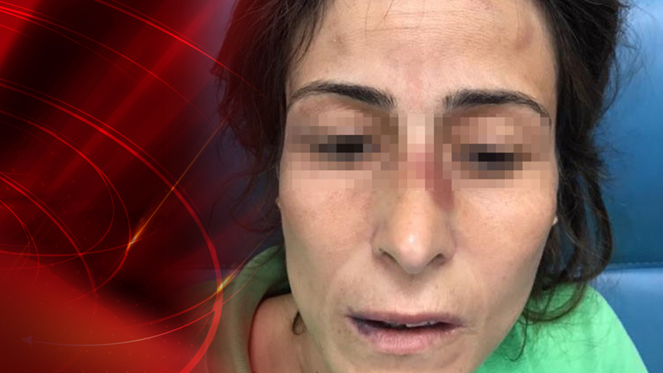 Eşinin kemiklerini kıran doktora takdir indirimi ile ceza çıkmadı!