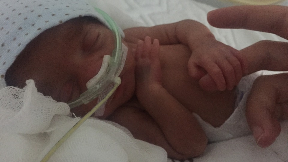 Parmak ikizler hayata böyle tutundu!