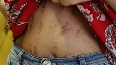 Uzmanlardan lazer epilasyon uyarısı!