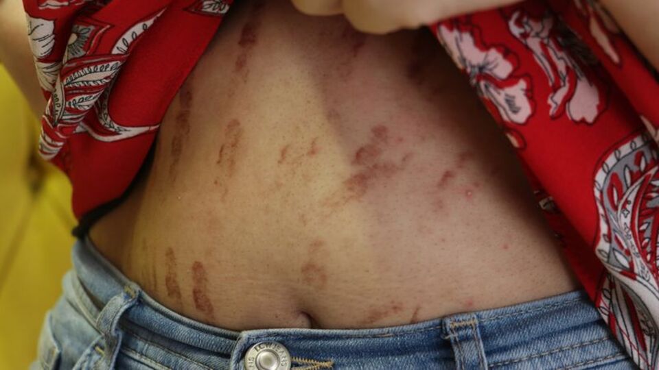 Uzmanlardan lazer epilasyon uyarısı!