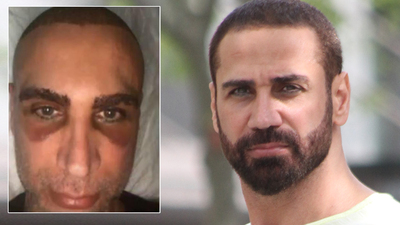 Doğuş saç ektirdi