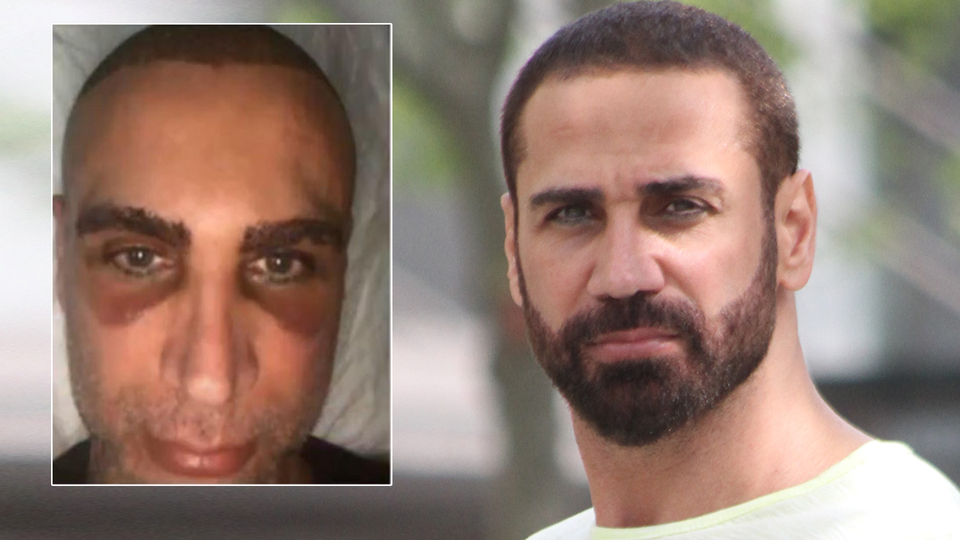 Doğuş saç ektirdi