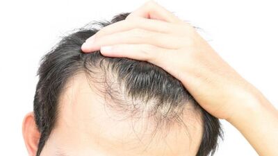 Saç ekiminde Avrupalılar Arapları geçti