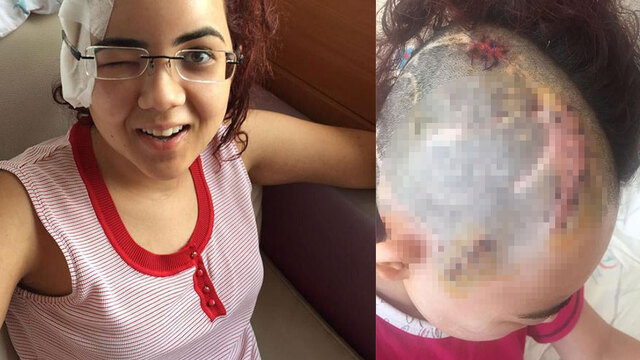 Mucizenin ta kendisi... Kafatasında 26 vida ve 6 plakla yaşıyor...