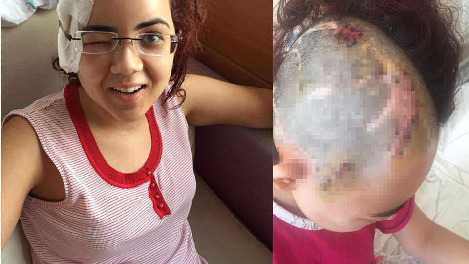 Mucizenin ta kendisi... Kafatasında 26 vida ve 6 plakla yaşıyor...