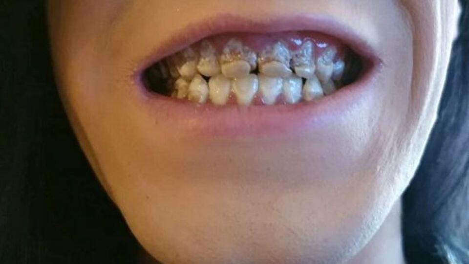 Dikkat! Sizin de başınıza gelebilir... Günde 6 şişe içince...