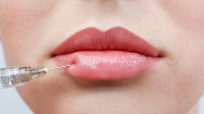 Lip lift nedir?