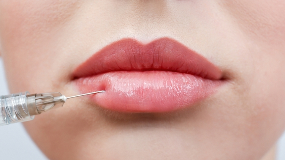 Lip lift nedir?
