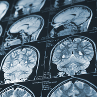 CCR5 geninin yoksunluğu inme sonrası iyileşmeyi hızlandırıyor