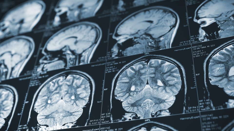 CCR5 geninin yoksunluğu inme sonrası iyileşmeyi hızlandırıyor