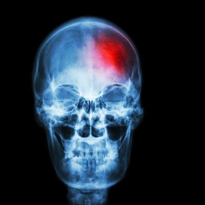 İnme geçiren kişiye aspirin verilmeli mi?