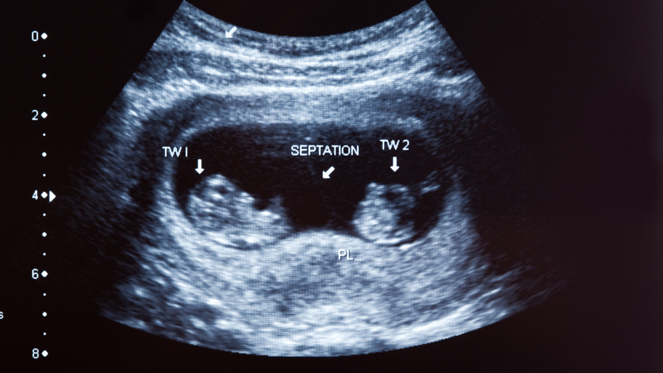 Bebeğin gebelik kesesinden kaybolmasının sebebi...