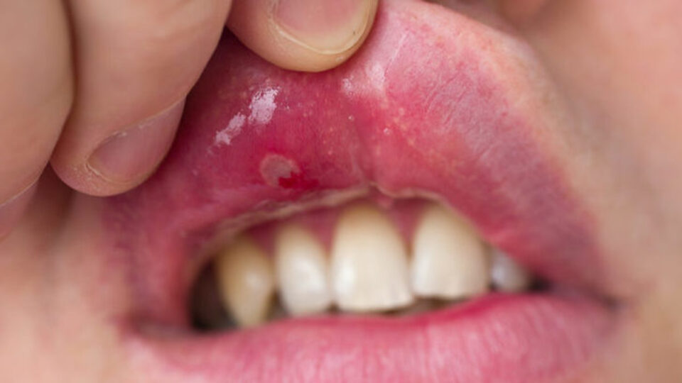 Ağız yaralarına ne iyi gelir?