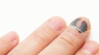 Dikkat! Sizin de başınıza gelebilir... Kemiğe kadar ilerliyor! Sonra da...