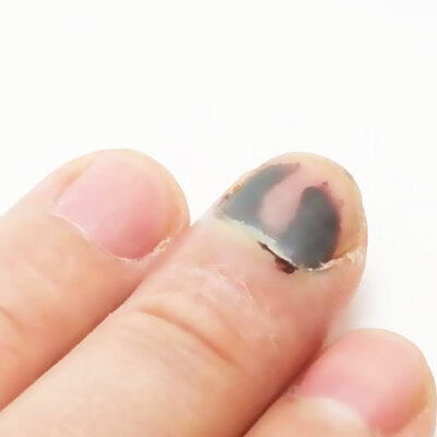 Dikkat! Sizin de başınıza gelebilir... Kemiğe kadar ilerliyor! Sonra da...