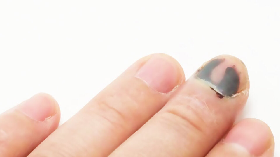 Dikkat! Sizin de başınıza gelebilir... Kemiğe kadar ilerliyor! Sonra da...