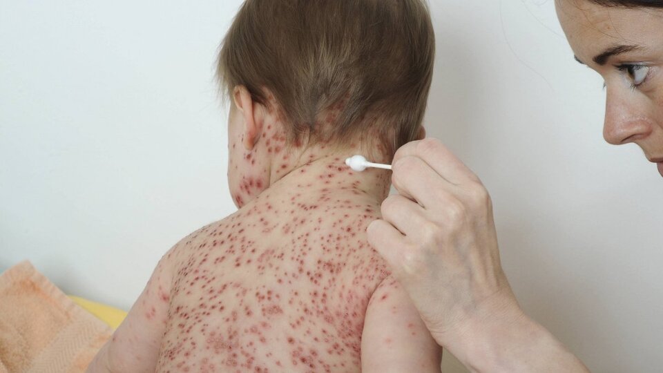 Çiçek hastalığı nedir?