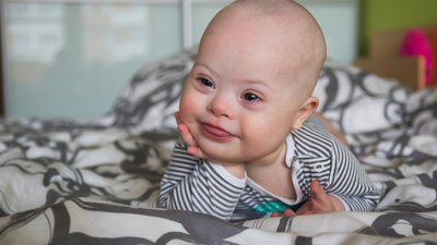 Down sendromu hastalık değil, farklılık!