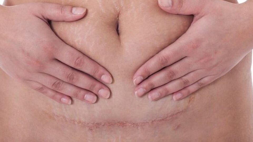 Dünya genelinde her yıl 300 bin kadın sezaryen doğum sonucu ölüyor