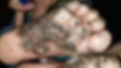 Ayaklarını pireler yedi!