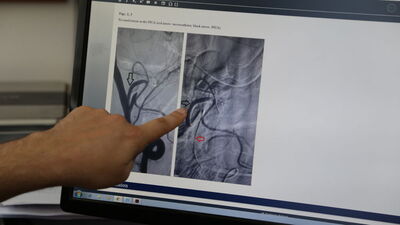 Beyin damarına "literatürlük" müdahale