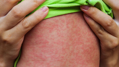 DSÖ: Kızamık vakaları 4 kat arttı!