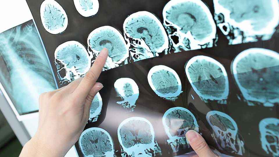 Alzheimer riskini erkenden uyaran yazılım!