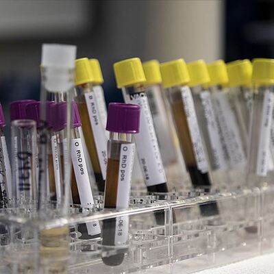 Kraliyet hastalığı diye biliniyor!