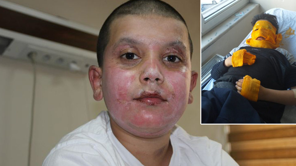 Sprey kutusu patladı! Feci şekilde yandı