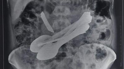 Midesinden kapı kilidi, tornavida, bıçak çıktı!